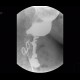 Bariatric surgery, pean: RF - Fluoroscopy