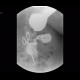 Bariatric surgery, pean: RF - Fluoroscopy
