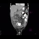 Perforation of ileum: CT - Computed tomography