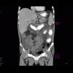 Perforation of ileum: CT - Computed tomography