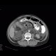Perforation of ileum: CT - Computed tomography