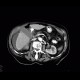 Perforation of gastric ulcer, stomach ulcer: CT - Computed tomography
