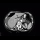 Perforation of gastric ulcer, stomach ulcer: CT - Computed tomography