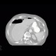 Perforation of gastric ulcer, stomach ulcer: CT - Computed tomography