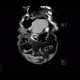 Perforation of gastric ulcer, stomach ulcer: CT - Computed tomography