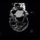 Perforation of gastric ulcer, stomach ulcer: CT - Computed tomography