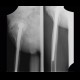 Periarticular ossifications after replacement of hip joint, pseudoarthrosis, false joint: X-ray - Plain radiograph