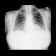 Ground-glass in acute leukemia, lymphocyte infiltration, peribronchovascular: X-ray - Plain radiograph