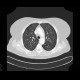 Ground-glass in acute leukemia, lymphocyte infiltration, peribronchovascular: CT - Computed tomography