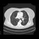 Ground-glass in acute leukemia, lymphocyte infiltration, peribronchovascular: CT - Computed tomography
