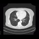 Ground-glass in acute leukemia, lymphocyte infiltration, peribronchovascular: CT - Computed tomography
