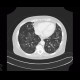 Ground-glass in acute leukemia, lymphocyte infiltration, peribronchovascular: CT - Computed tomography