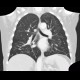 Ground-glass in acute leukemia, lymphocyte infiltration, peribronchovascular: CT - Computed tomography