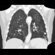 Ground-glass in acute leukemia, lymphocyte infiltration, peribronchovascular: CT - Computed tomography