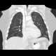 Ground-glass in acute leukemia, lymphocyte infiltration, peribronchovascular: CT - Computed tomography