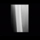 Periostosis of femur: X-ray - Plain radiograph