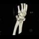 Perilunate luxation, VRT: CT - Computed tomography