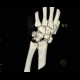 Perilunate luxation, VRT: CT - Computed tomography