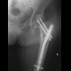 Intertrochanteric hip fracture, osteosynthesis, dynamic screws: X-ray - Plain radiograph