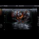 Plantar lymphoma: US - Ultrasound