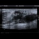Plantar lymphoma: US - Ultrasound
