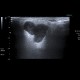 Pleomorphic adenoma, parotid gland: US - Ultrasound