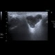 Pleomorphic adenoma, parotid gland: US - Ultrasound