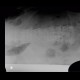 Pleural fluid, lateral view, decubitus view: CT - Computed tomography