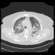 Pumonary edema, pneumonia: CT - Computed tomography