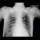 Pulmonary edema, second day: X-ray - Plain radiograph