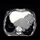 Pulmonary embolism, pulmonary hypertension, cardiomegally, correlation: CT - Computed tomography