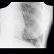 Lung infarction: X-ray - Plain radiograph