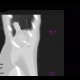 Lung infarction: CT - Computed tomography
