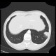 Lung infarction: CT - Computed tomography