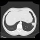 Lung infarction: CT - Computed tomography