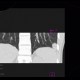 Lung infarction: CT - Computed tomography