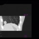 Lung infarction: CT - Computed tomography