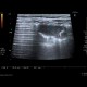 Lung infarction: US - Ultrasound
