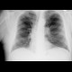 Lung tumour, adjacent to the left hilum: X-ray - Plain radiograph