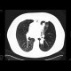 Lung tumour, adjacent to the left hilum: CT - Computed tomography