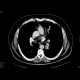 Lung tumour, adjacent to the left hilum: CT - Computed tomography