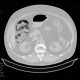 Pneumatosis intestinalis: CT - Computed tomography