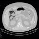 Pneumatosis intestinalis: CT - Computed tomography