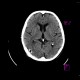 Pneumocephalus: CT - Computed tomography