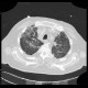 Pneumocystis carinii, HRCT: CT - Computed tomography