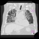 Pneumocystis carinii, HRCT: CT - Computed tomography