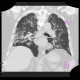 Pneumocystis carinii, HRCT: CT - Computed tomography