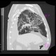 Pneumocystis carinii, HRCT: CT - Computed tomography