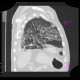 Pneumocystis carinii, HRCT: CT - Computed tomography