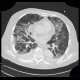Pneumocystis carinii, HRCT: CT - Computed tomography